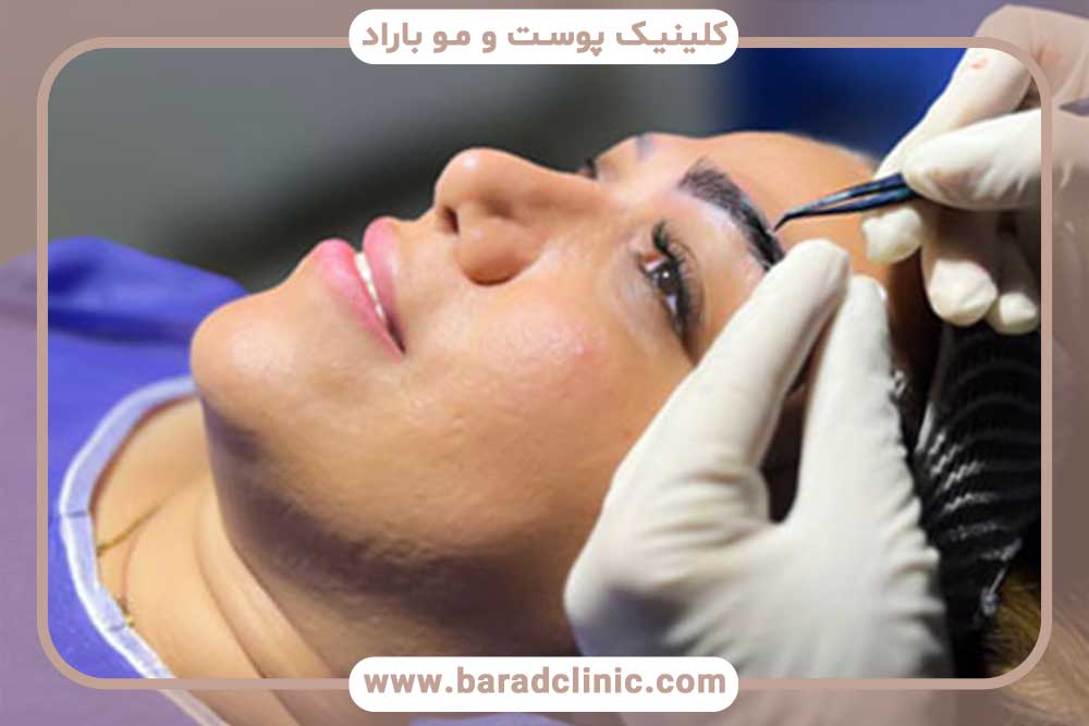 هزینه کاشت ابرو در بهترین کلینیک‌های شمال تهران