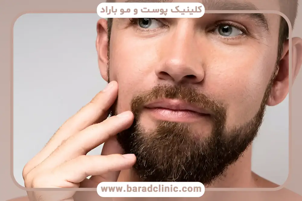 نحوه کاشت ریش