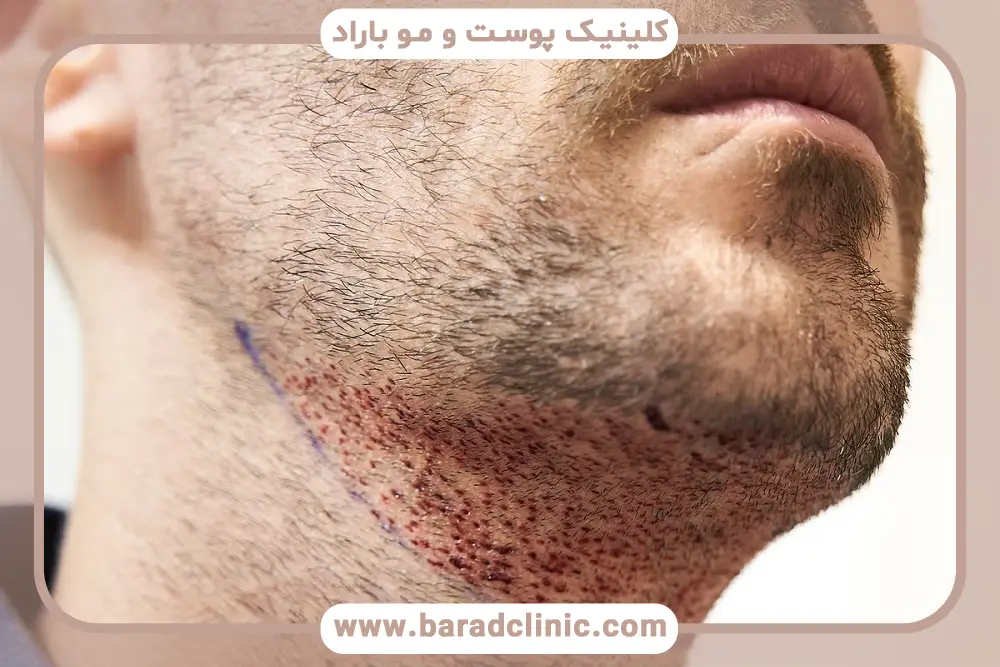کلینیک کاشت ریش تهران
