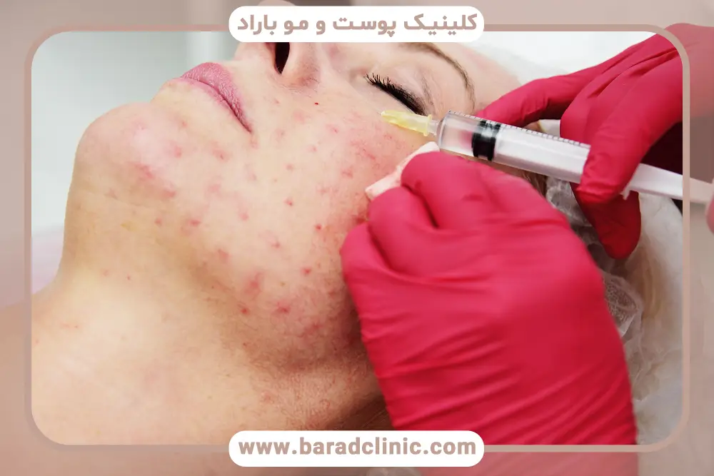 پروسیجر prp چیست