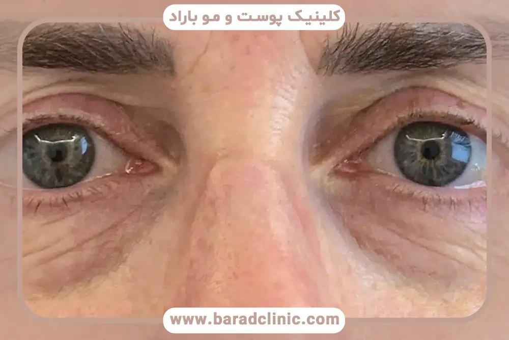 علت کوچک شدن چشم بعد از عمل بلفاروپلاستی