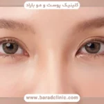 بلفاروپلاستی ترکیبی