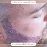 زخم کاشت ریش