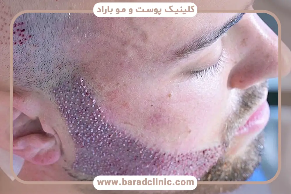 زخم کاشت ریش