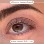 ریزش مژه بعد از بلفاروپلاستی