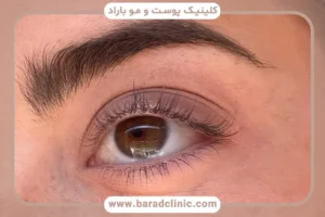 ریزش مژه بعد از بلفاروپلاستی