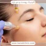 برای مزوتراپی مو چند سی سی لازم است