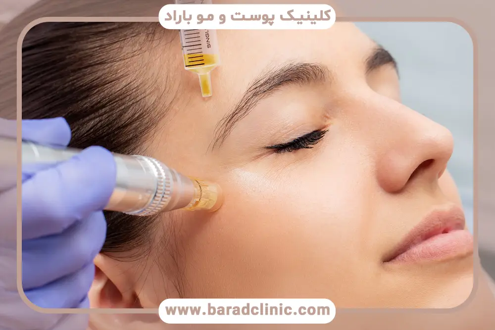 برای مزوتراپی مو چند سی سی لازم است