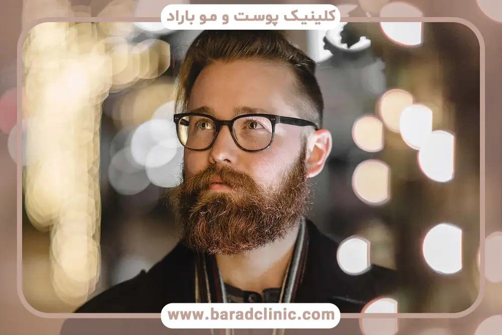 کاشت ریش کامل