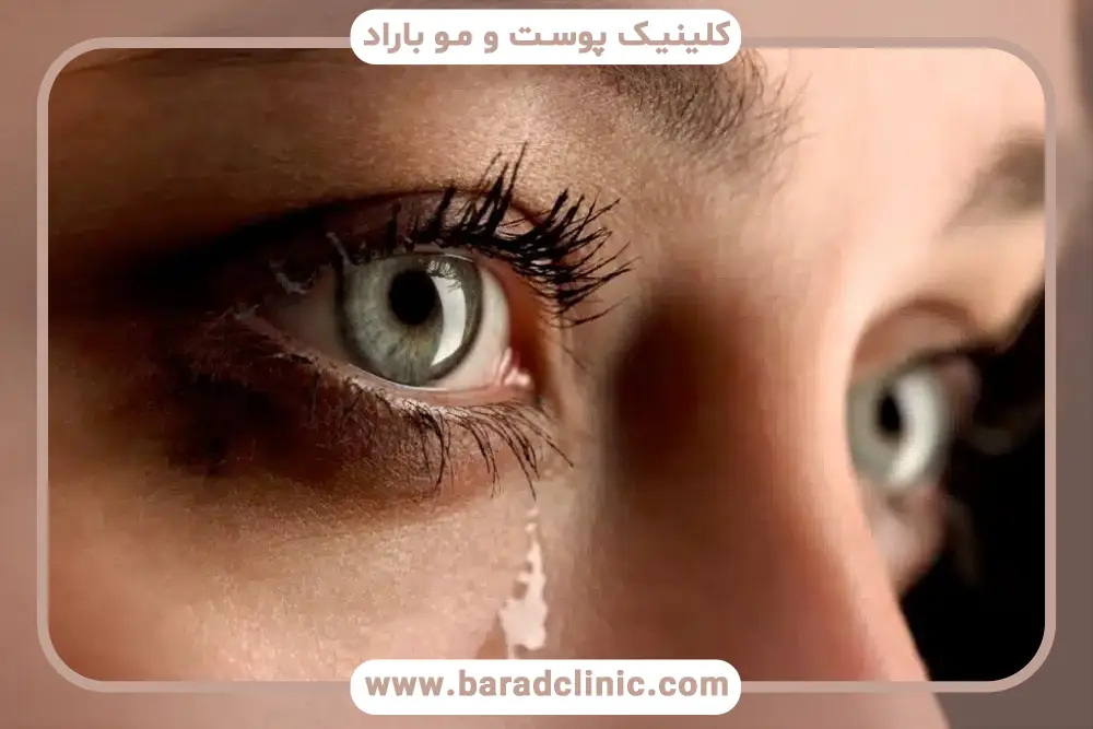 علت آبریزش چشم بعد از عمل بلفاروپلاستی