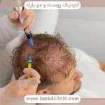 مزوتراپی برای ریزش هورمونی مو