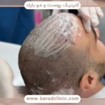 دوران نقاهت کاشت مو