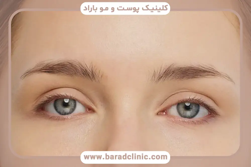 هزینه بلفاروپلاستی با لیزر