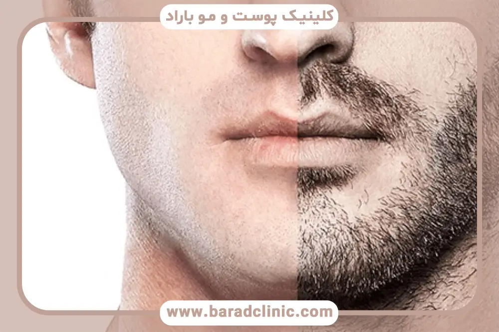 عوارض کاشت ریش و سبیل