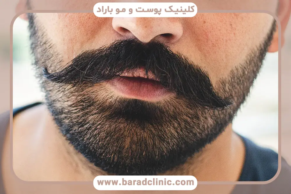 بهترین روش برای کاشت ریش