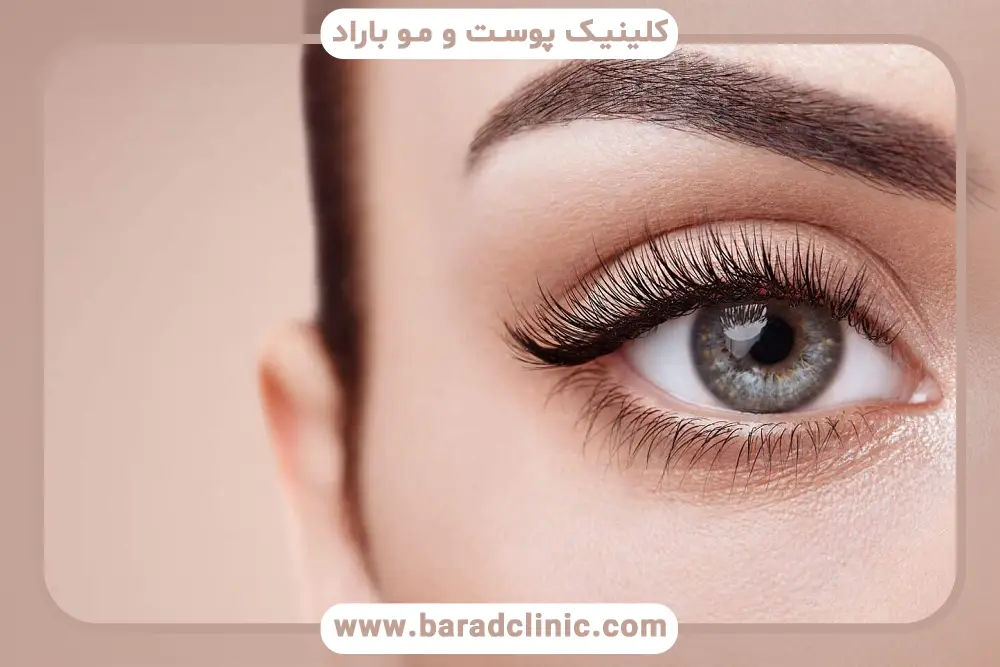 مزایای عمل بلفاروپلاستی پلک بالا