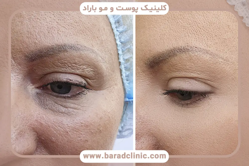 مزوتراپی برای چروک دور چشم