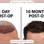 دوره کاشت مو