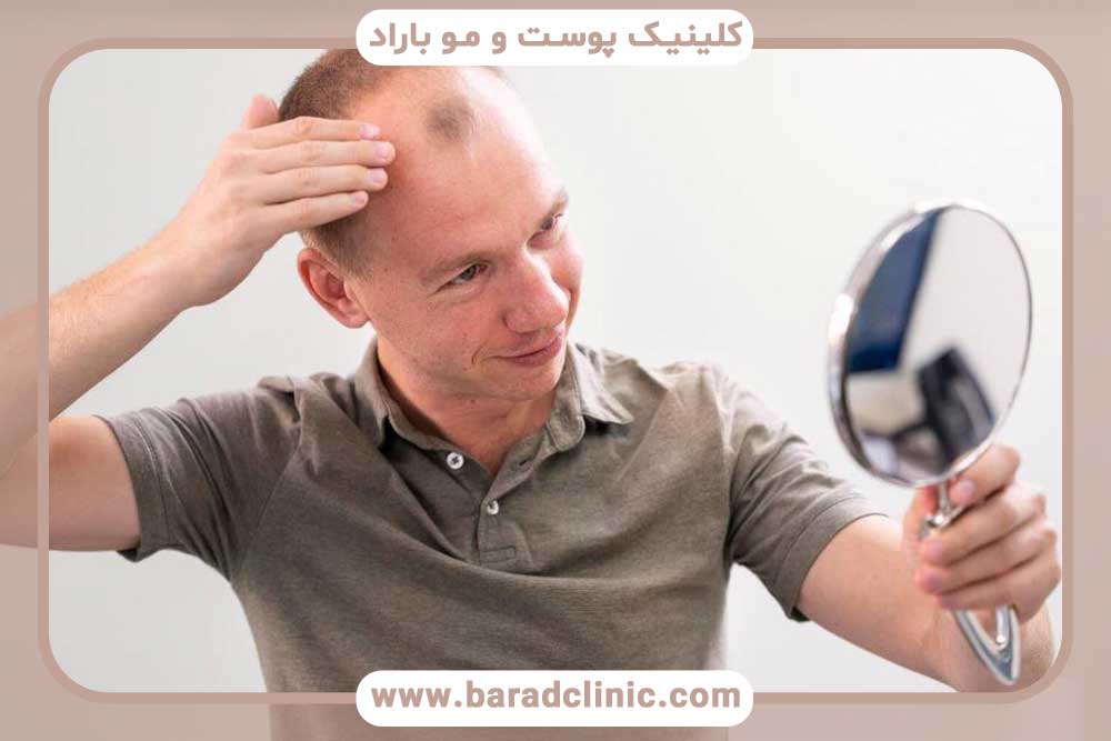 بیماری‌های ریزش مو