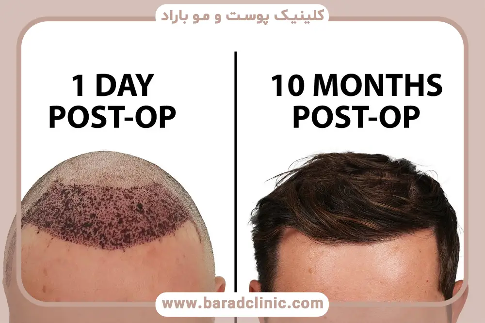 دوره کاشت مو