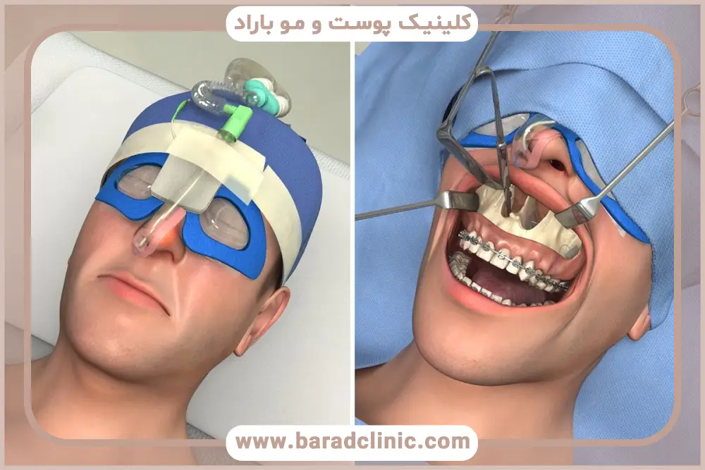 پروسیجر لفورت