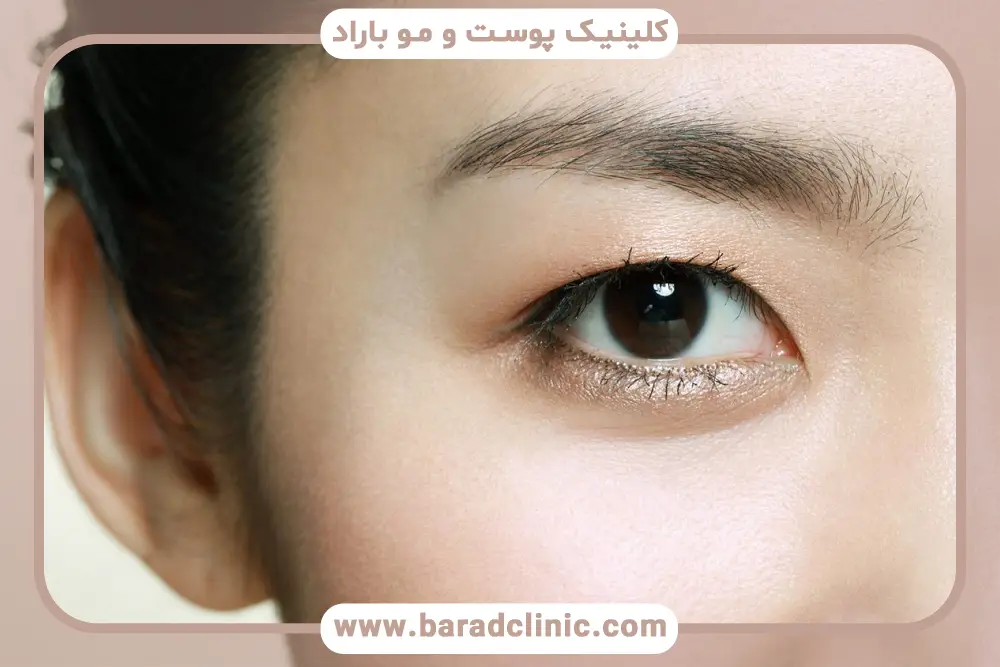 بهترین سن برای عمل بلفاروپلاستی