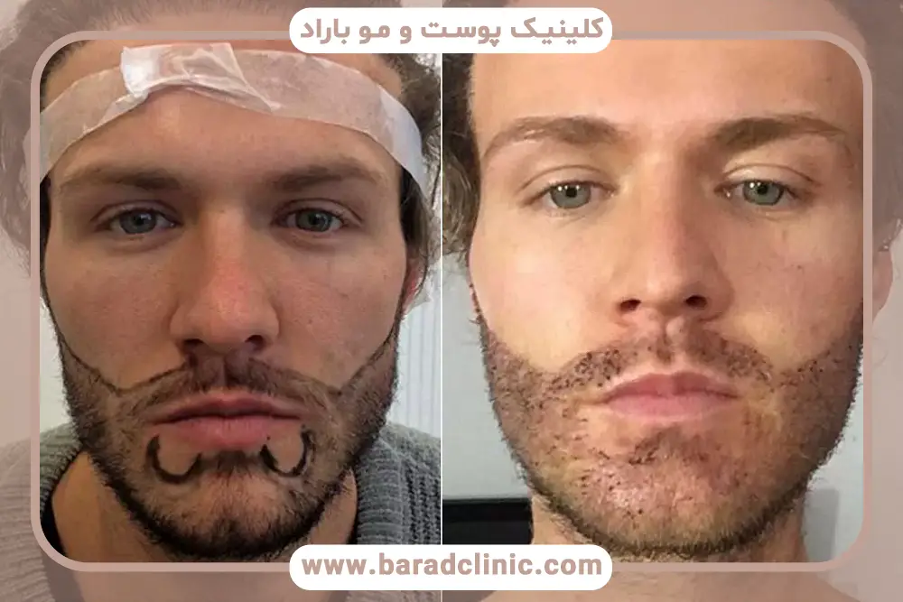 دوره نقاهت کاشت ریش