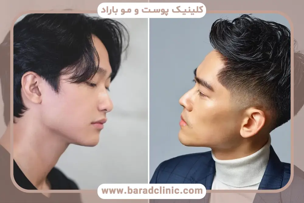 تبلیغات کاشت مو، واقعیت یا اغراق؟