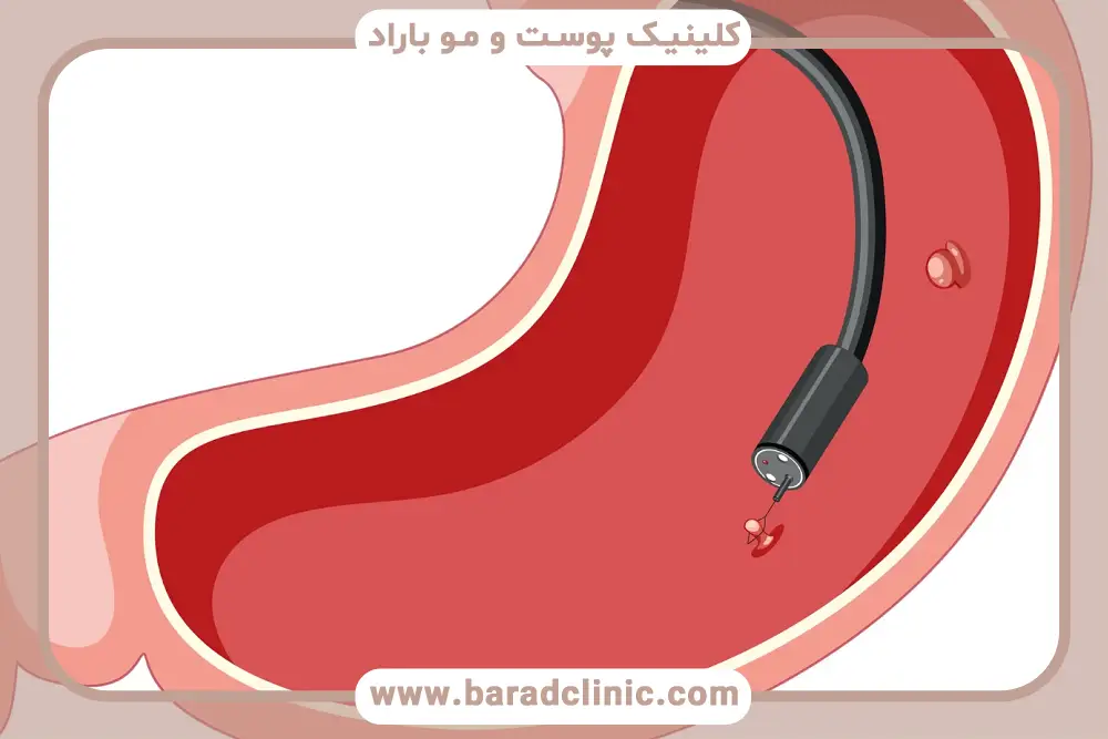 خدمات بوتاکس معده چیست