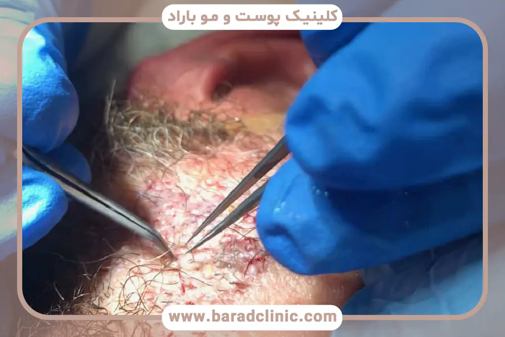 اهمیت انتخاب بهترین جراح کاشت ریش در ایران