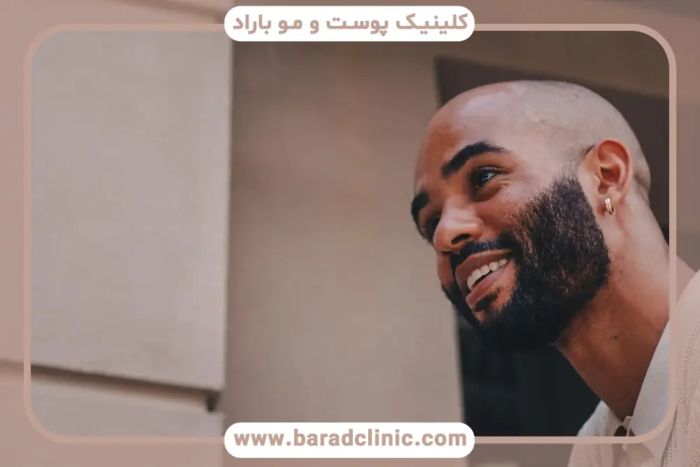 انواع روشها در عمل کاشت ریش