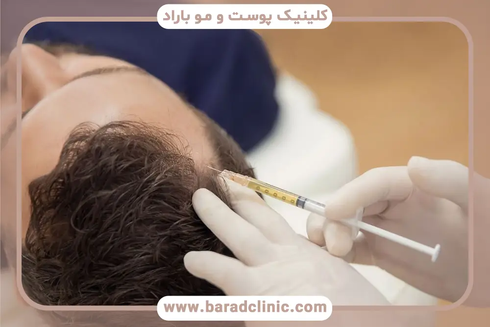 مزایای prp موها