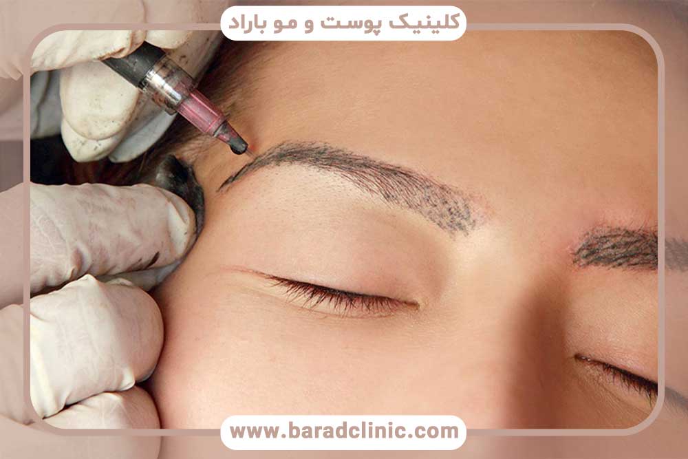 کاشت ابرو طبیعی در تهران