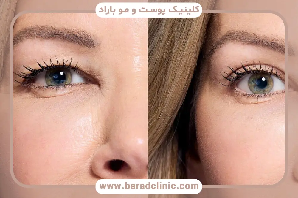 آمادگی قبلی برای دریافت بهترین نتیجه نهایی عمل بلفاروپلاستی 