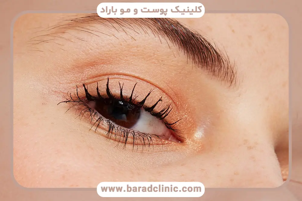 اهمیت انتخاب بهترین مرکز بلفاروپلاستی در تهران 