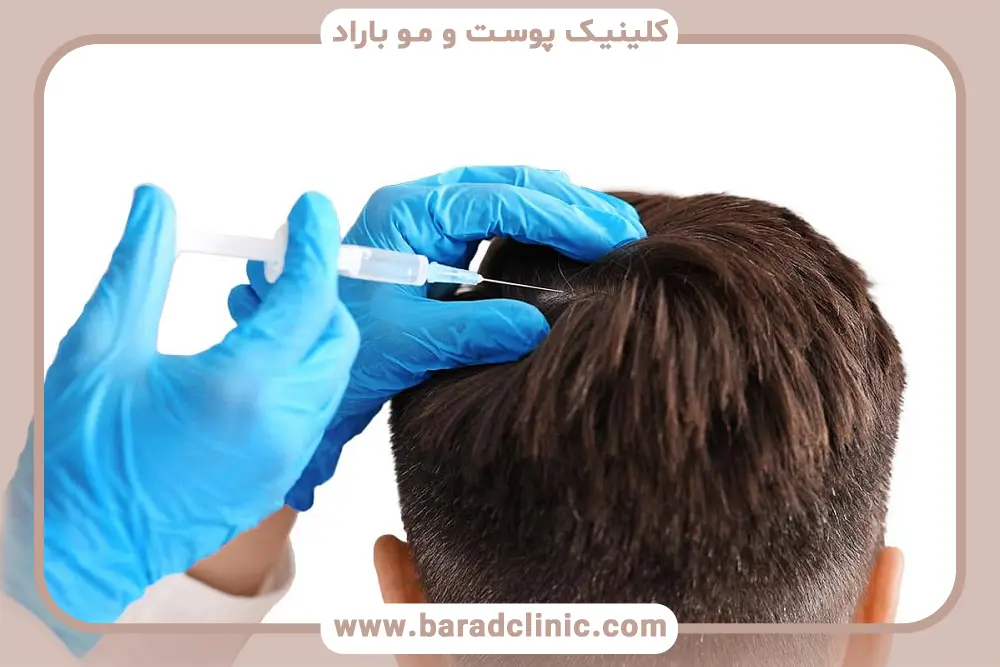 مزایای مزوتراپی برای پرپشتی مو