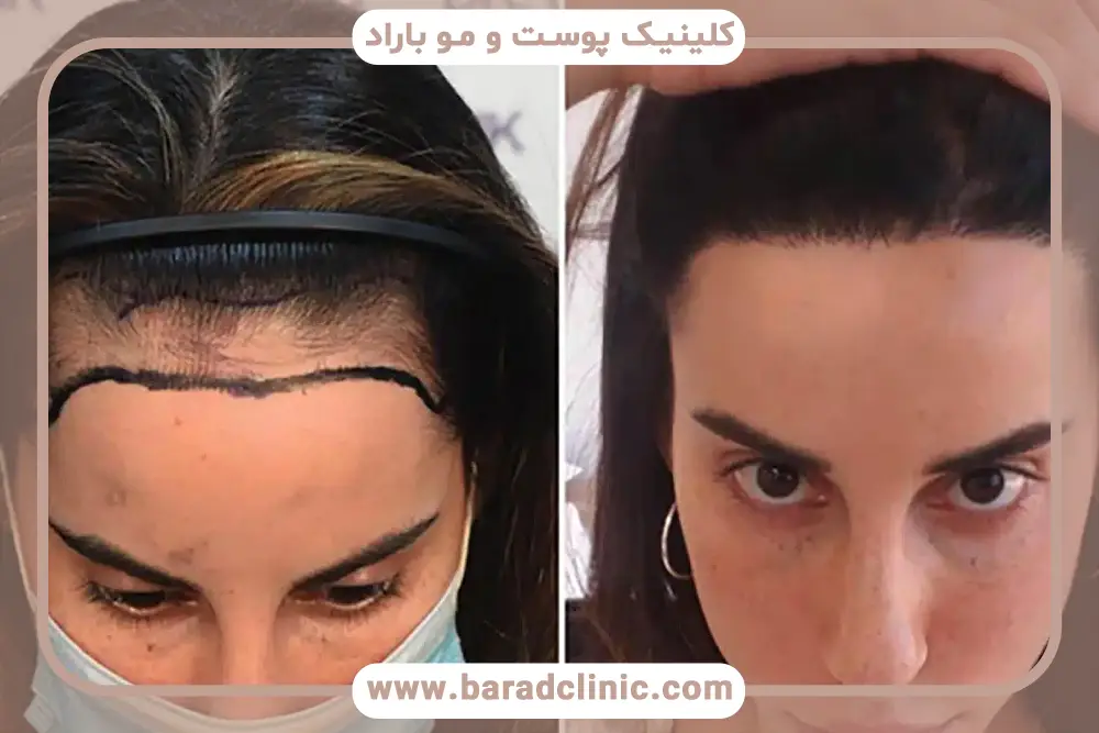 مزایای بررسی فیلم کاشت مو به روش sut