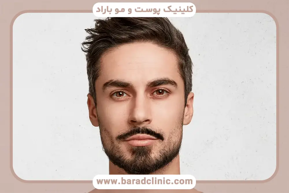 خدمات کاشت ریش در صورت