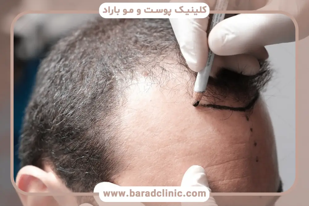 اهمیت انتخاب کلینیک کاشت مو در تهران