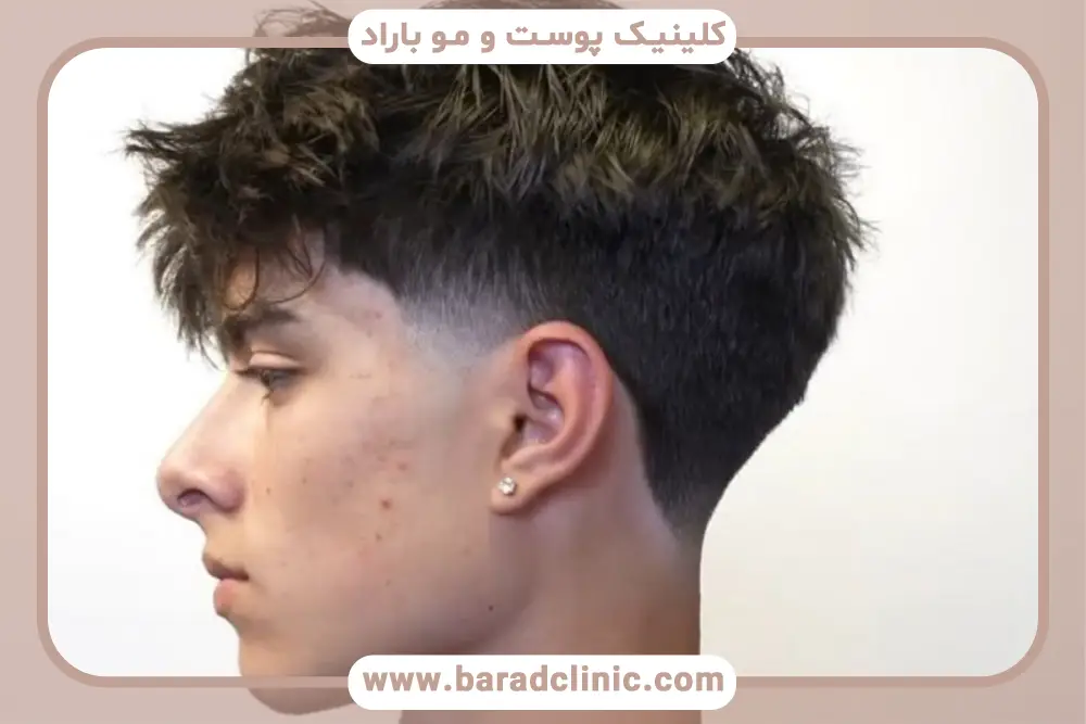 آشنایی با کاشت مو به روش fut