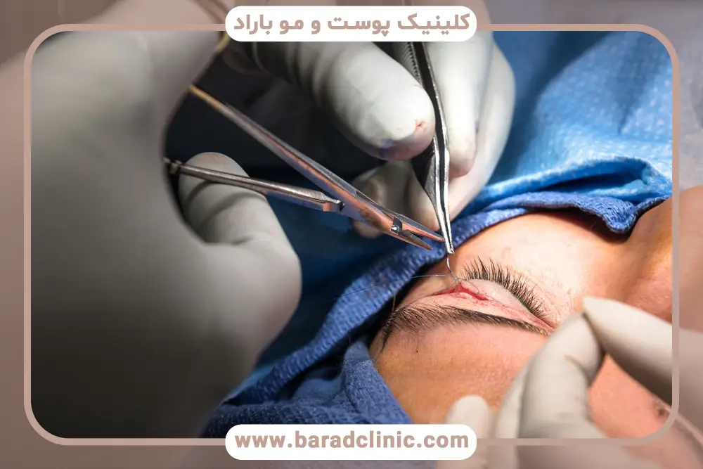 شایع‌ترین عوارض بلفاروپلاستی