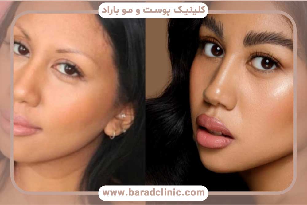 هزینه کاشت ابرو در بهترین کلینیک‌های شمال تهران