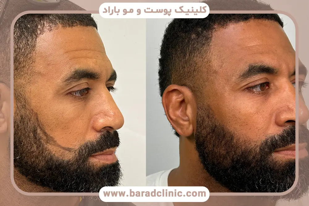 معیارهای انتخاب کلینیک کاشت ریش تهران