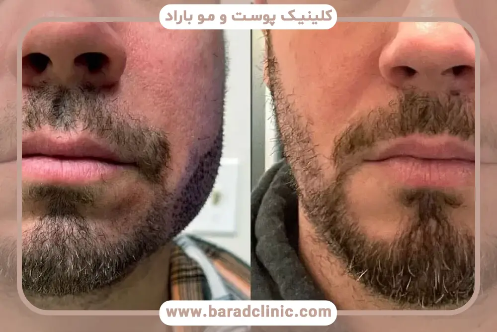 مراحل آماده‌سازی قبل از کاشت ریش زیر لب