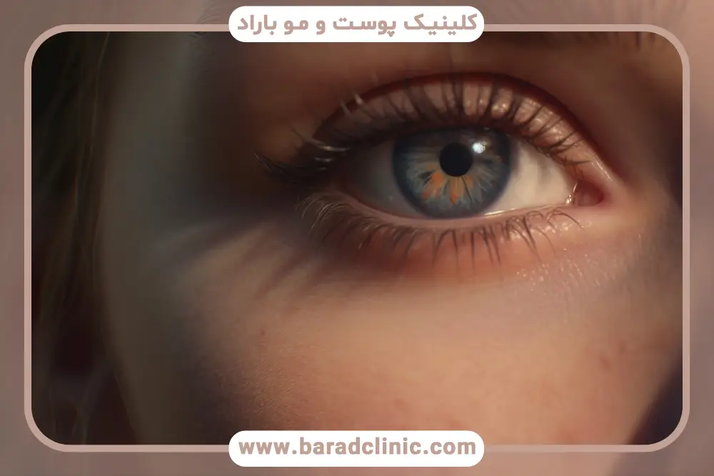 بلفاروپلاستی ترکیبی چیست؟