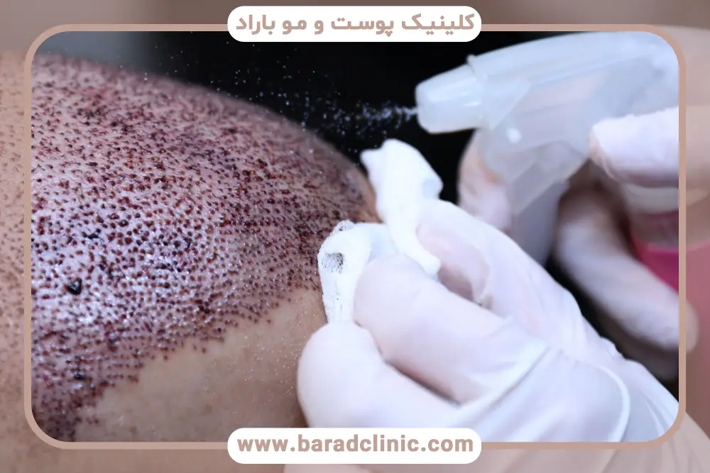 آشنایی با اسپری نیتروگلیسیرین برای کاشت مو 