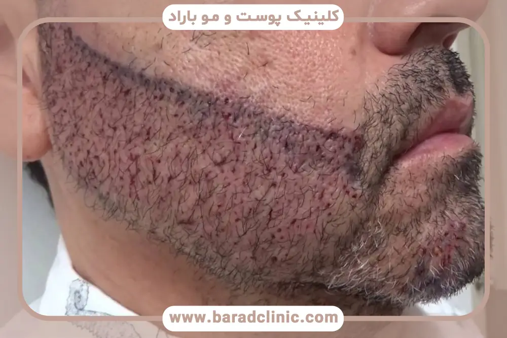 زخم کاشت ریش چیست؟ 