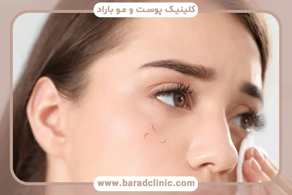 دلایل ریزش مژه بعد از بلفاروپلاستی