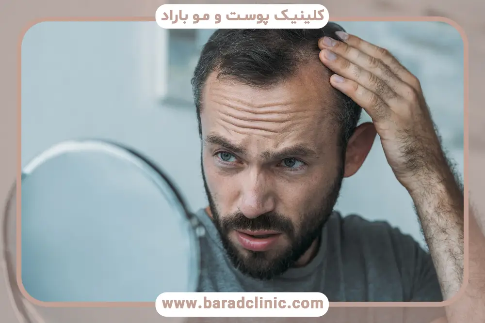 بررسی فیلم کاشت مو به روش سلولهای بنیادی