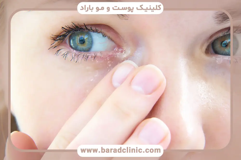 خشکی چشم یک علت آبریزش چشم بعد از عمل بلفاروپلاستی